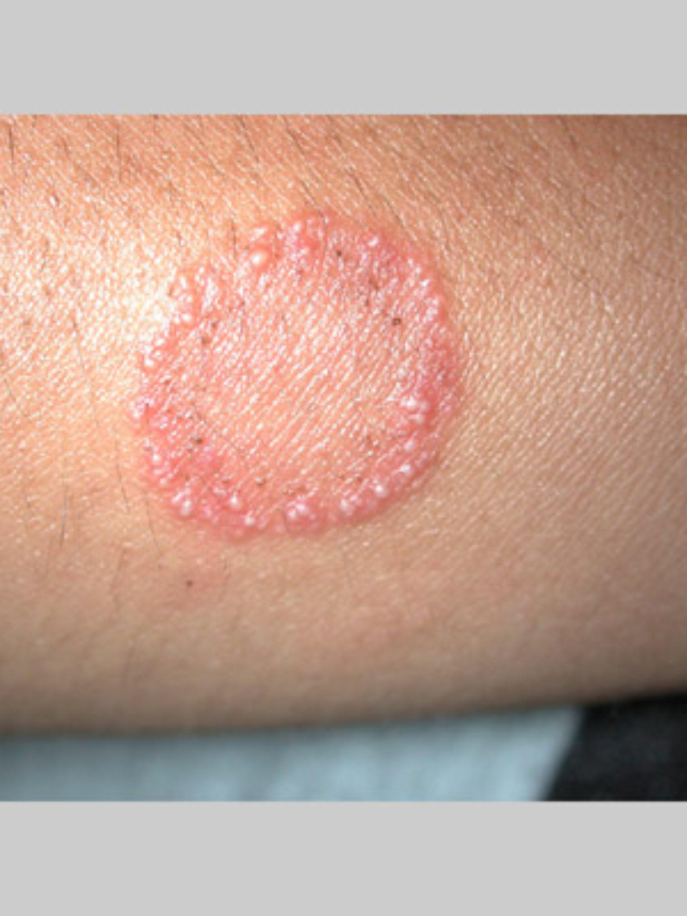 Diagnosis and treatment of fungal skin infections by dermatologists at SkinNU Clinics Kokapet