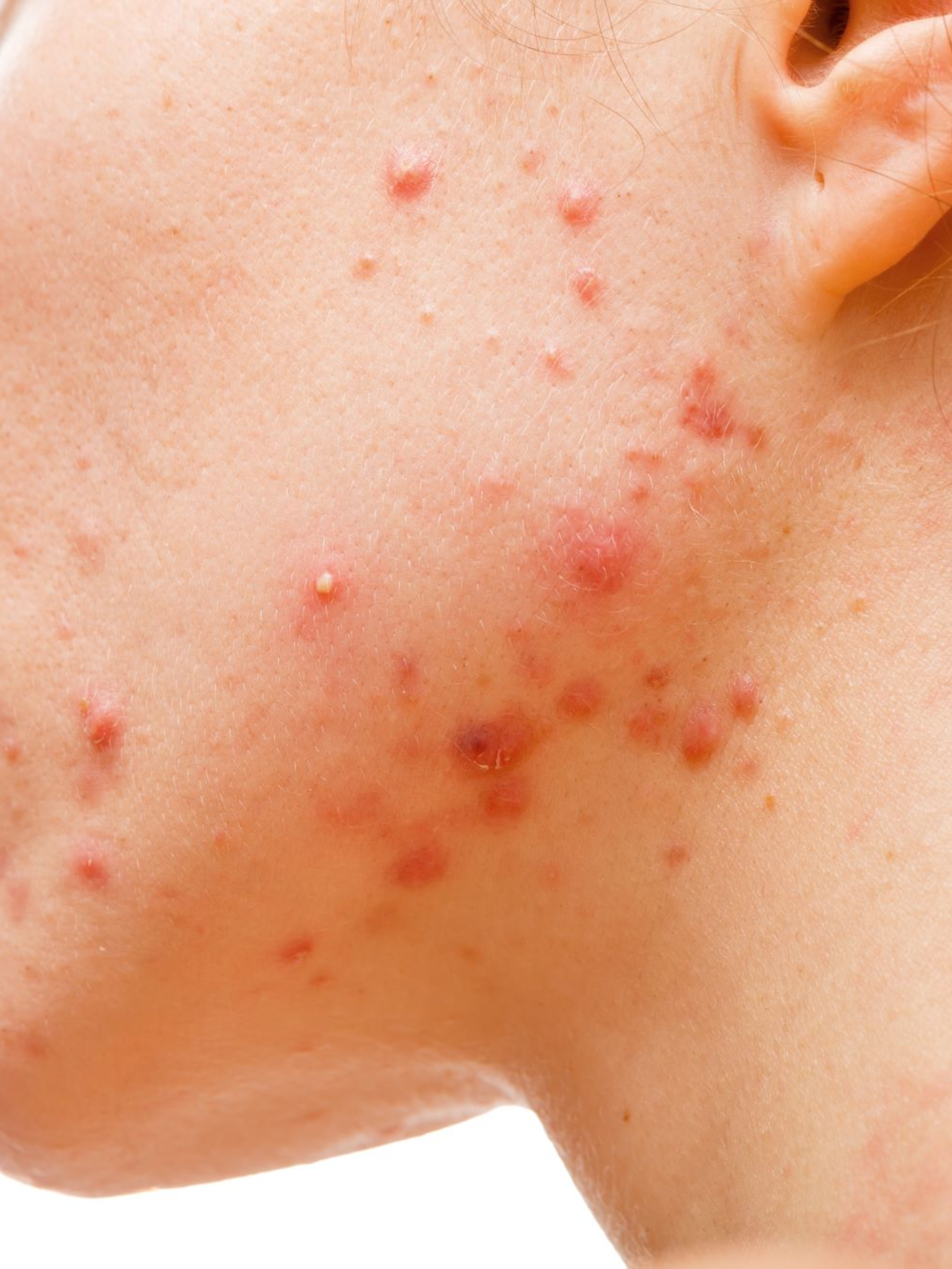 Adult acne versus hormonal acne explained by dermatology experts at SkinNU Clinics Kokapet