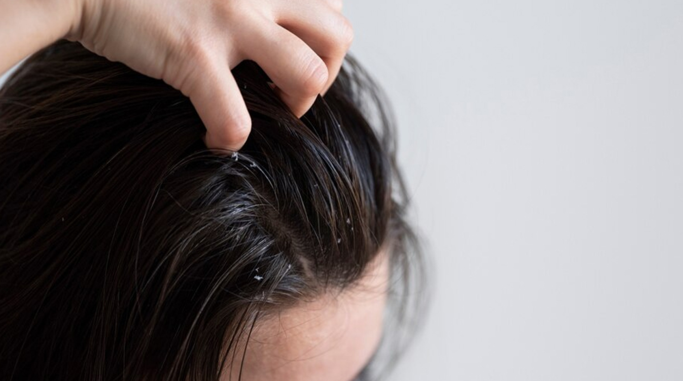 Monsoon dandruff, itchy scalp and hair fall care by Dr Divya Banswada, Dermatologist in Kokapet, Hyderabad