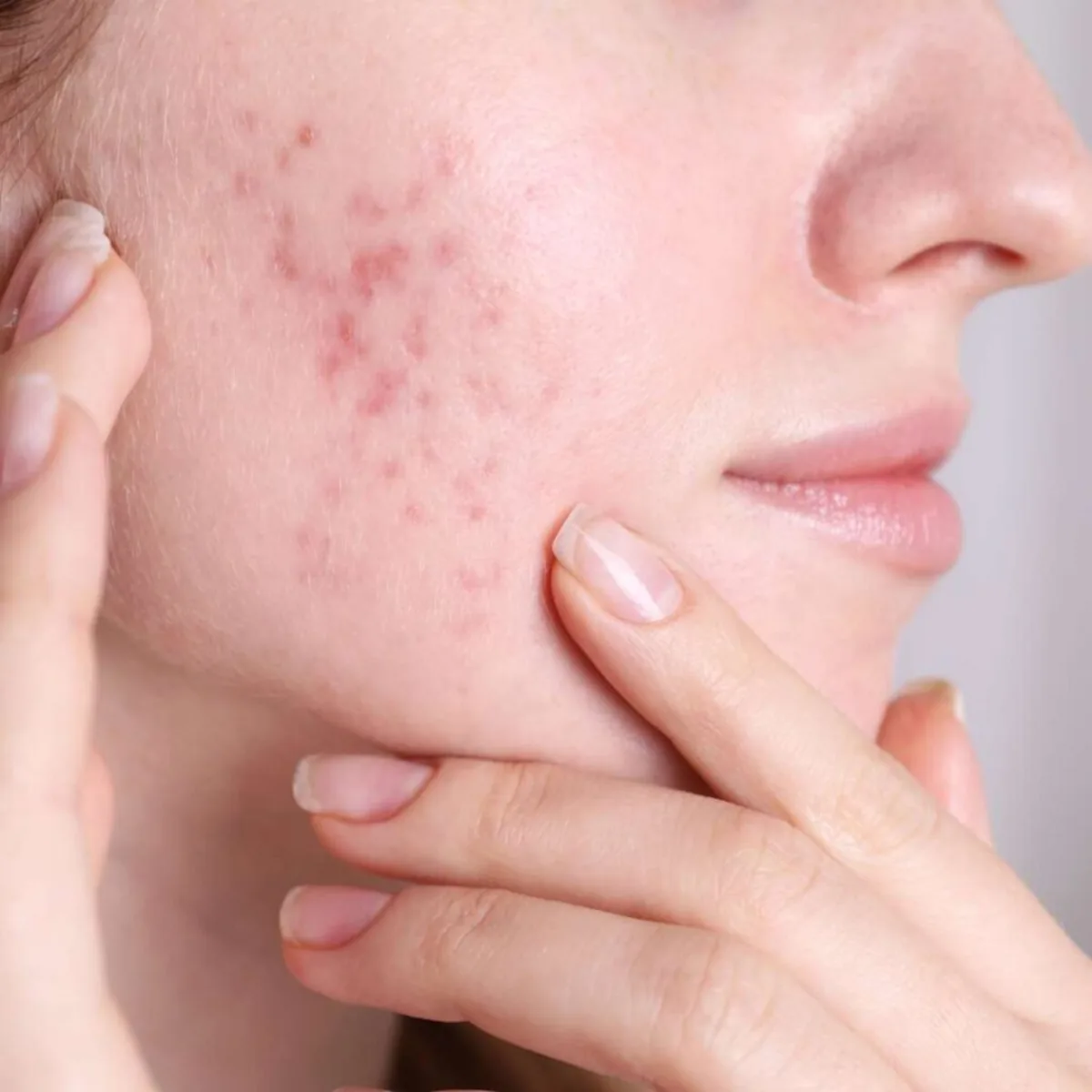 Acne & Scar Management at Skin N U Clinics, Kokapet