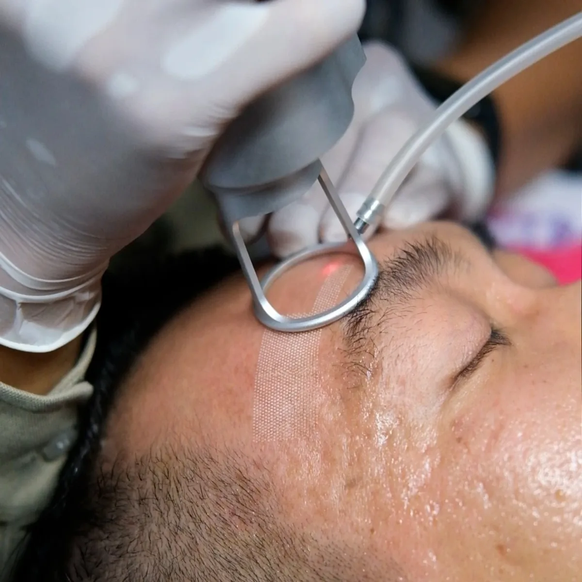 Acne Scar Resurfacing (Fractional CO2 Laser) at Skin N U Clinics, Kokapet
