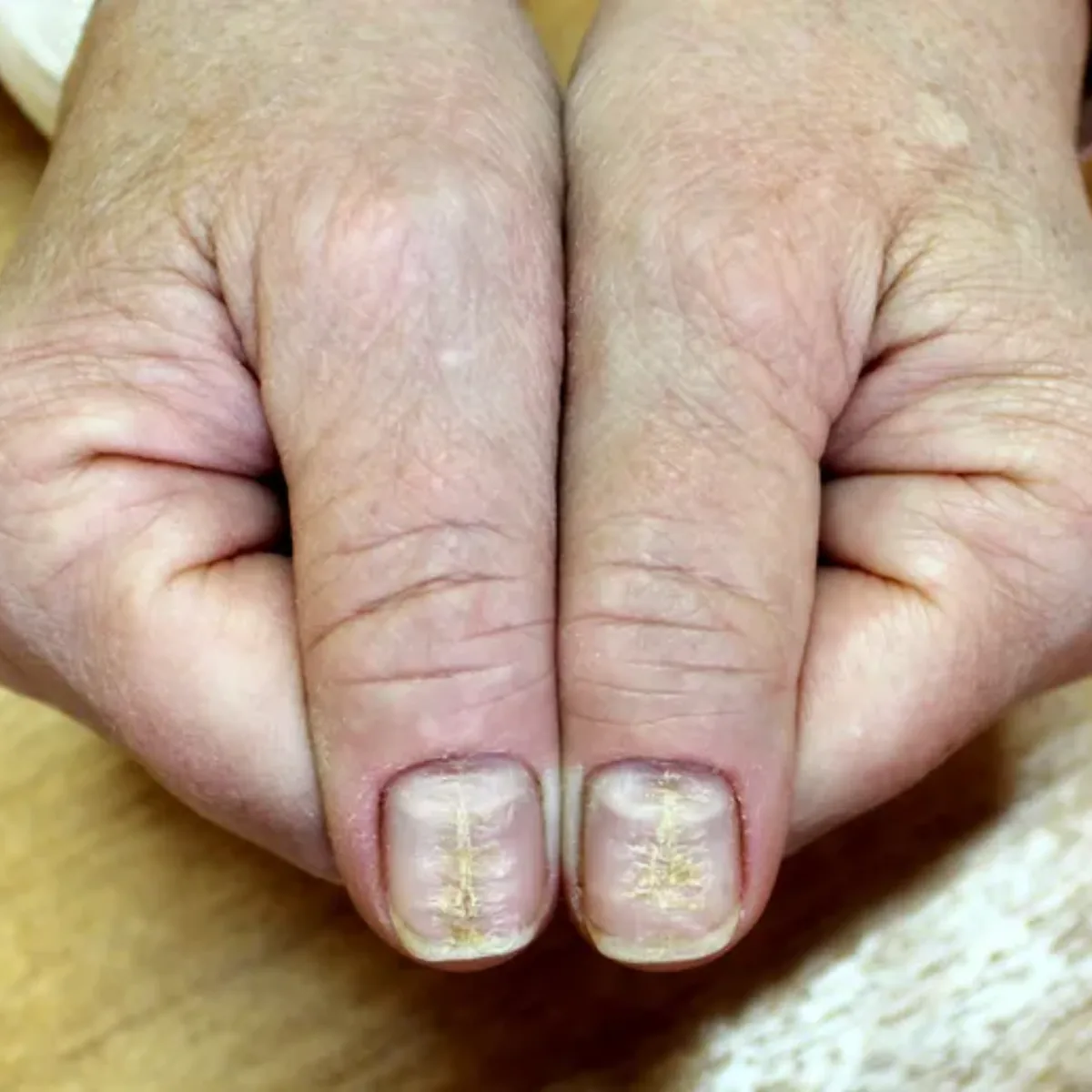 Nail Disorder Treatments at Skin N U Clinics, Kokapet
