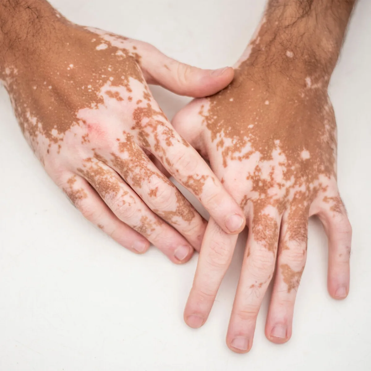 Psoriasis, Eczema & Vitiligo Management at Skin N U Clinics, Kokapet