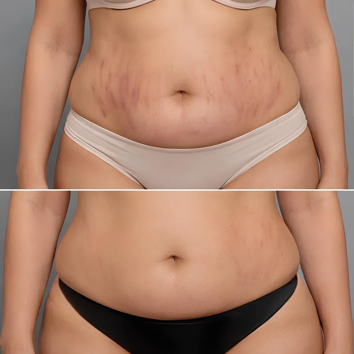 Stretch Mark Reduction at Skin N U Clinics, Kokapet